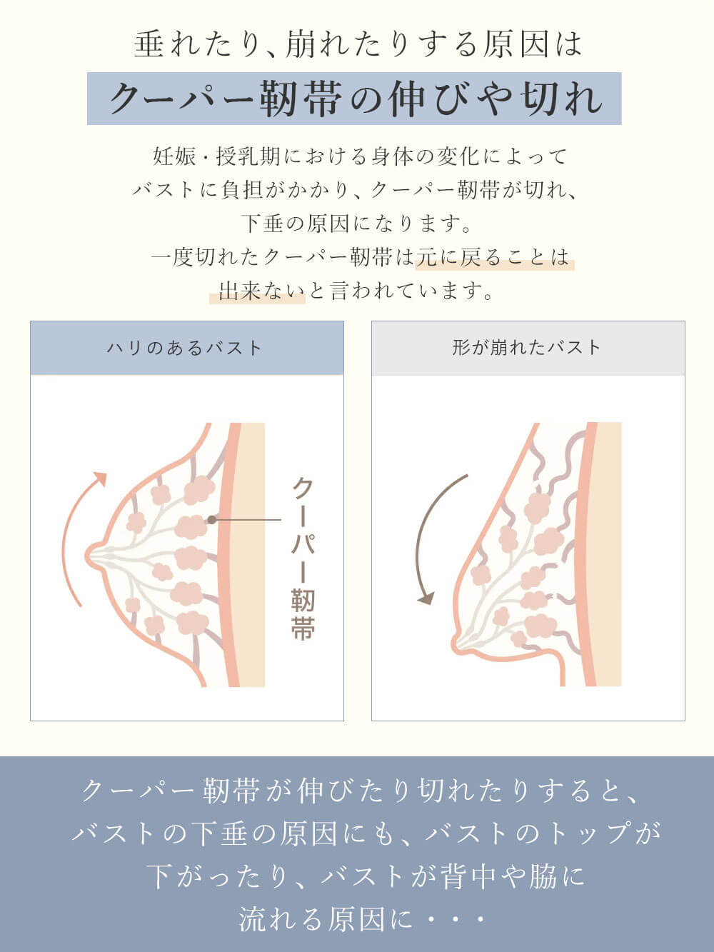 垂れたり、崩れたりする原因はクーパー靭帯の伸びや切れ