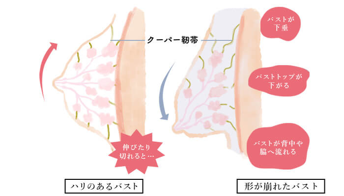 クーパー靭帯の伸び・切れ